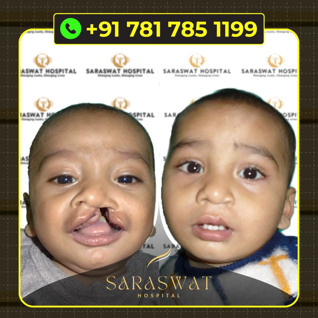 Best Age For Cleft Palate Repair