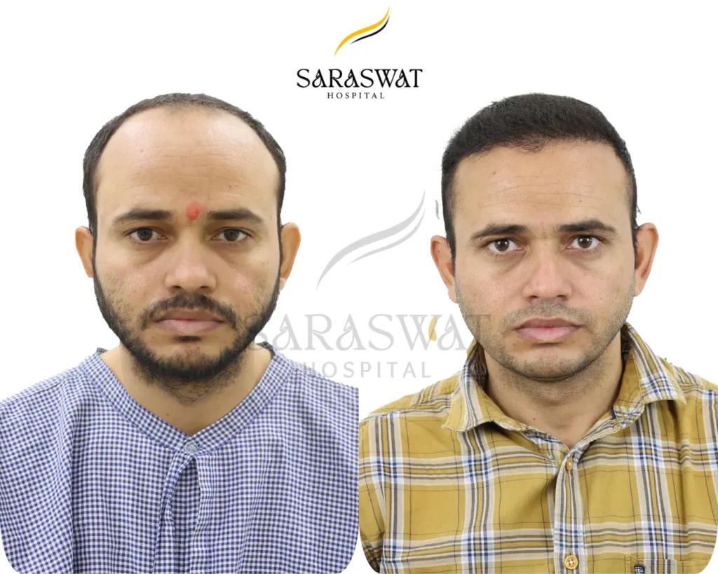 Hair Transplant Before and After Result