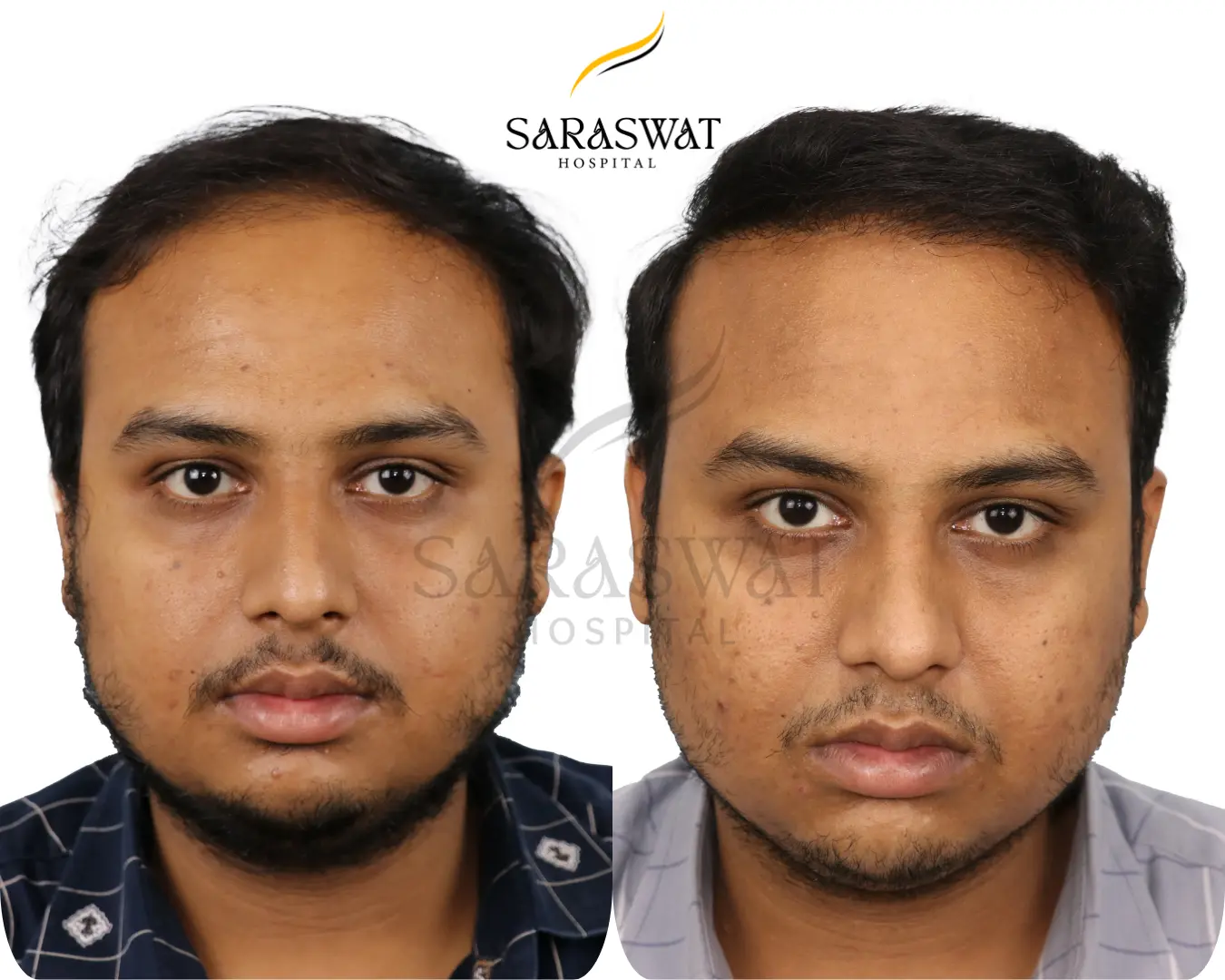 Hair Transplant Result