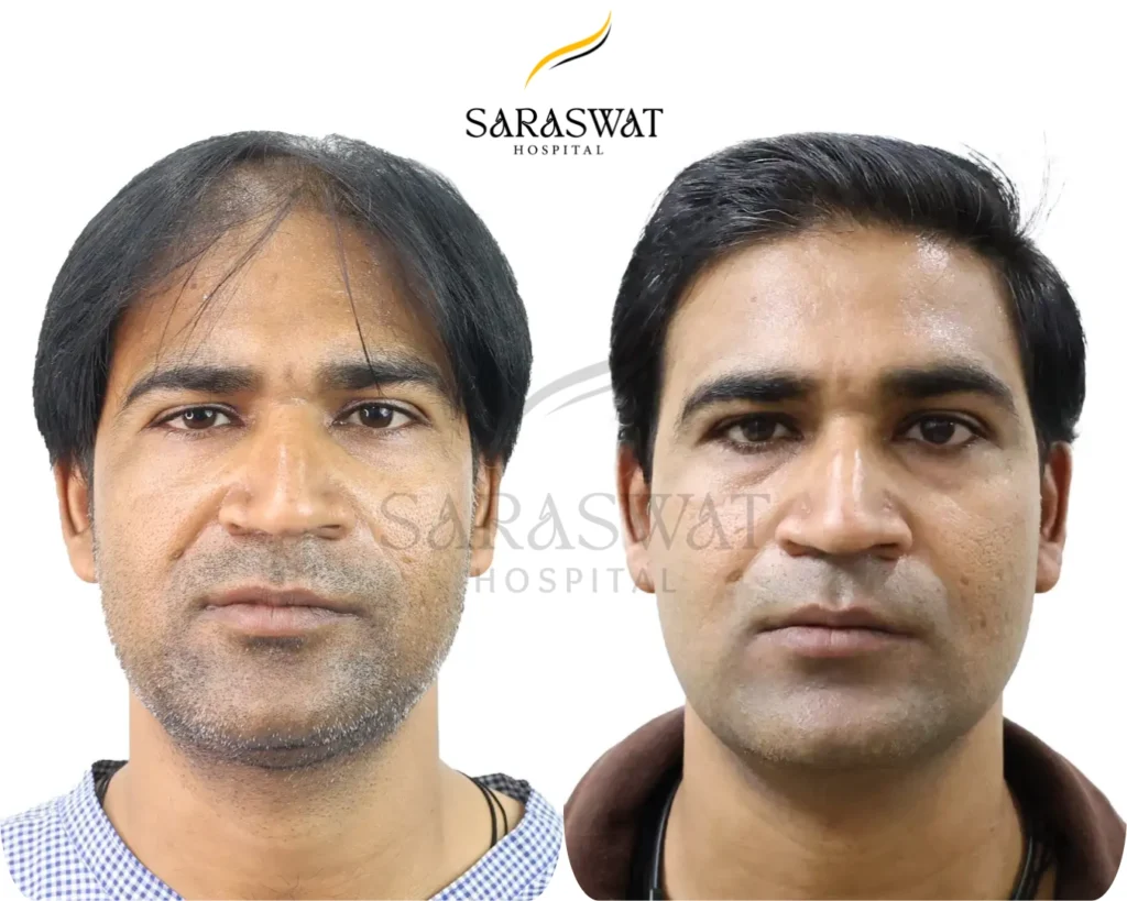 Hair Transplant Before and After Result