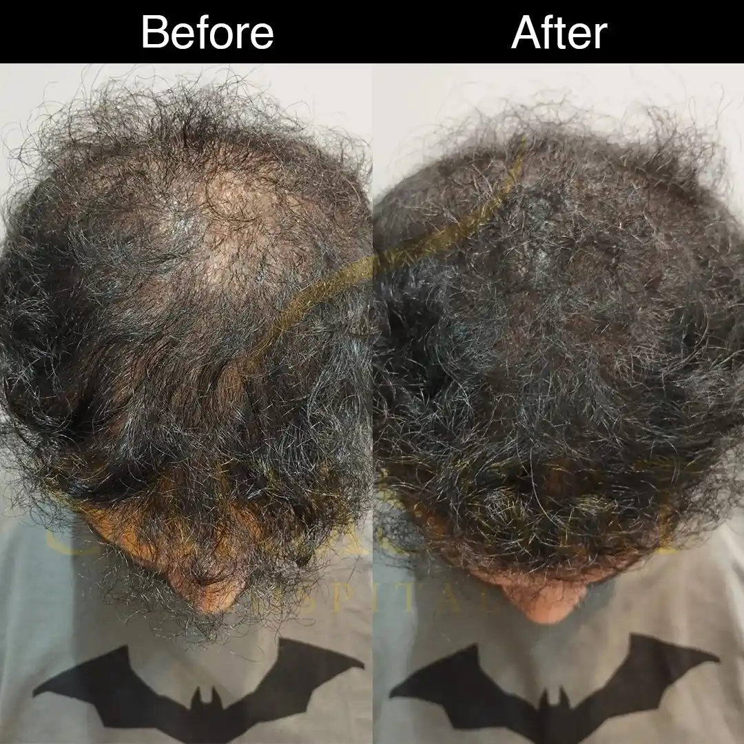 Scalp Micropigmentation Before After Result