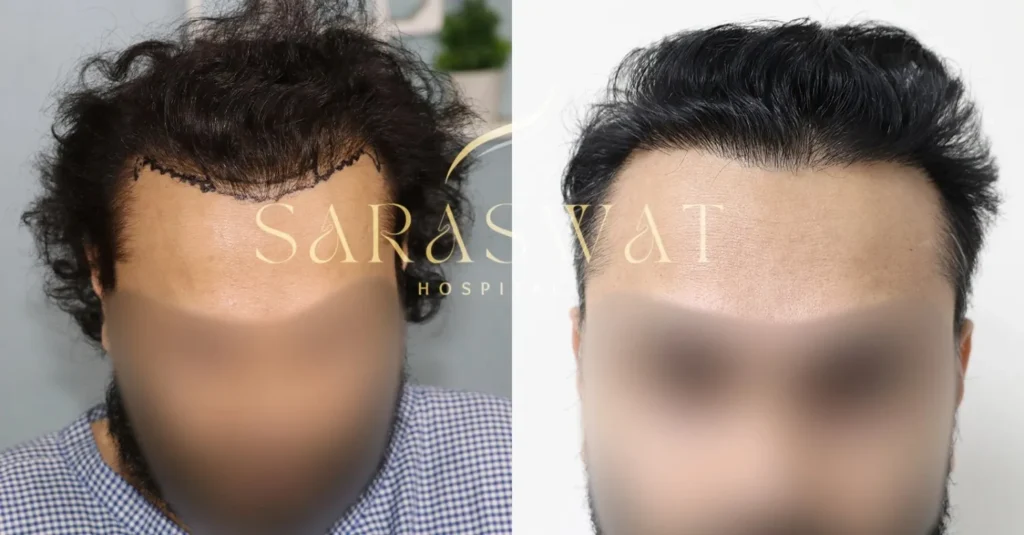 Repair Hair Transplant Result
