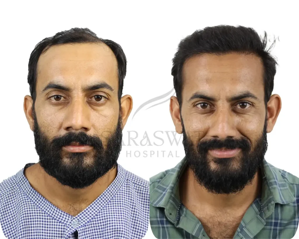 Our Motto for Hair Transplant & Cosmetic Treatments