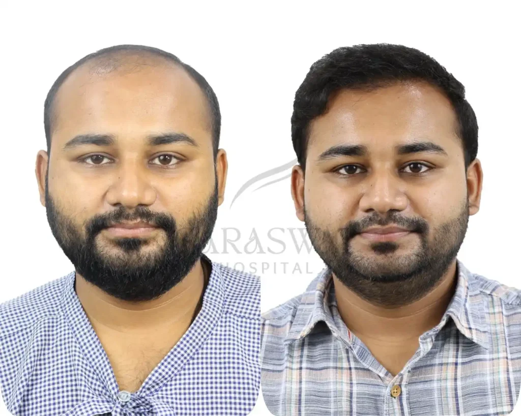 Hair transplant result
