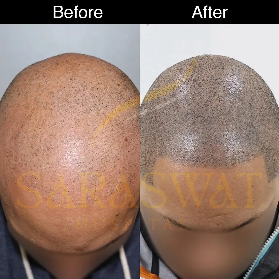 Scalp Micropigmentation Before After Result