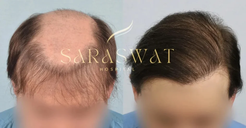 Body hair transplant result