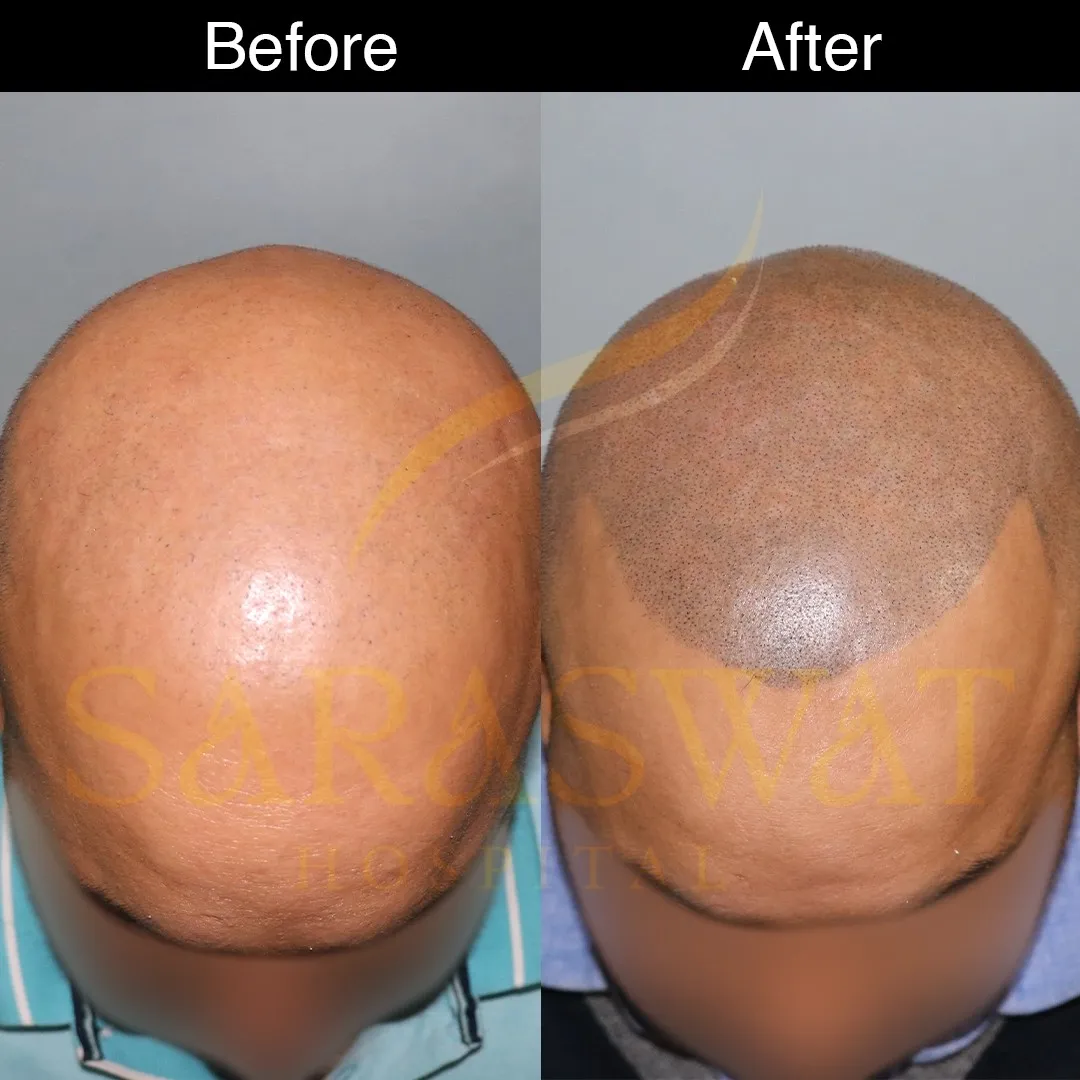 Scalp Micropigmentation Before and After