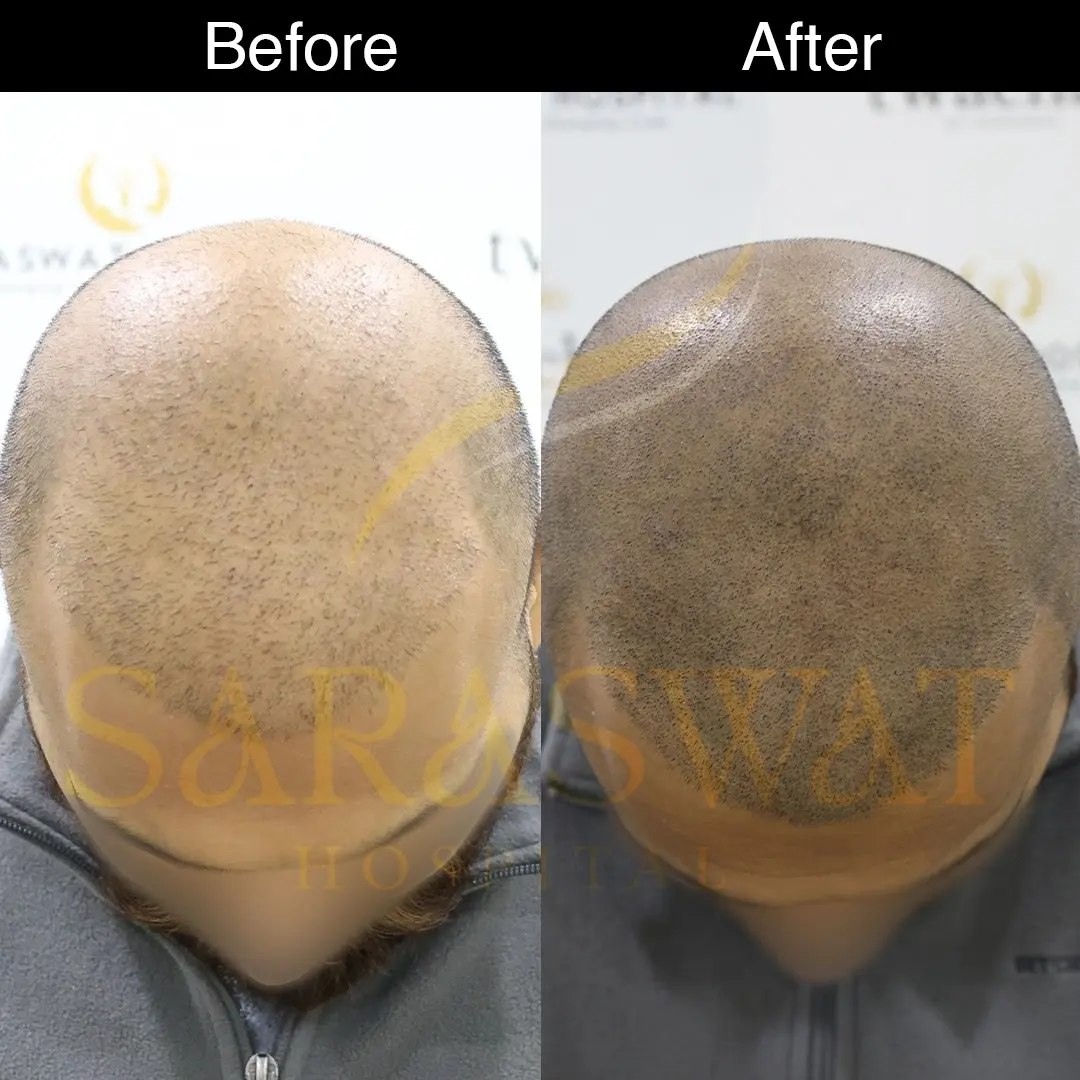 Scalp Micropigmentation Before and After