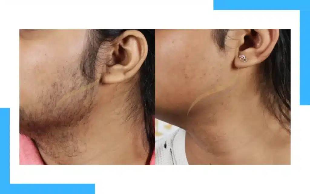 Laser Hair Removal Result