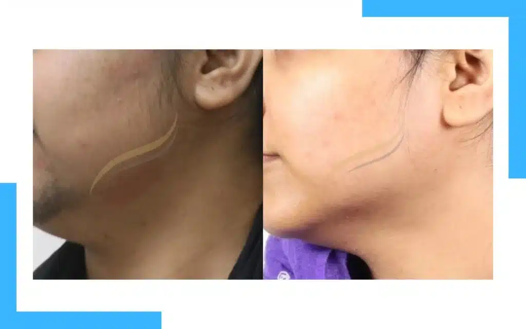 Facial Laser Hair Removal Result