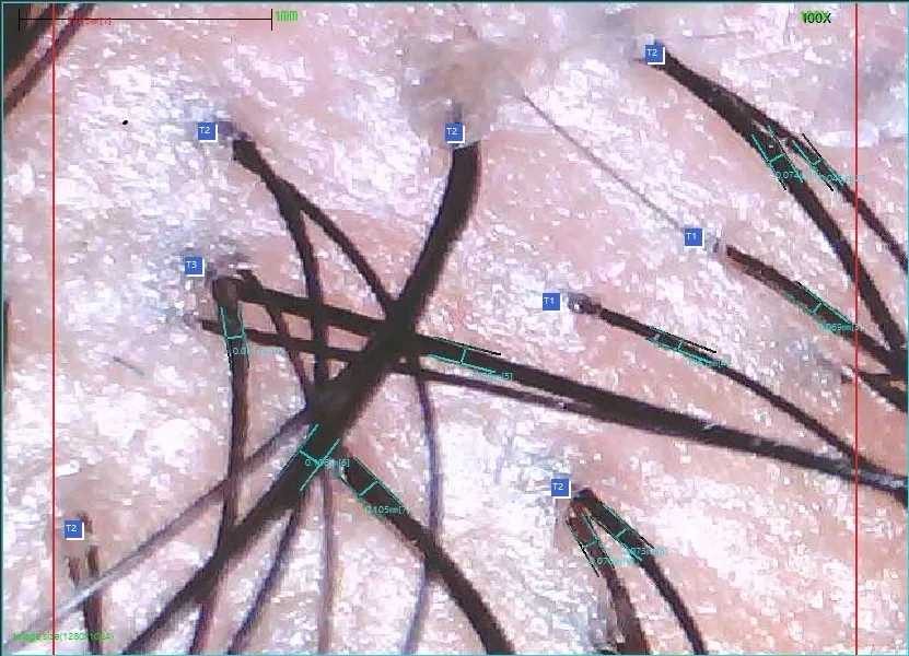 Follicle units on the scalp