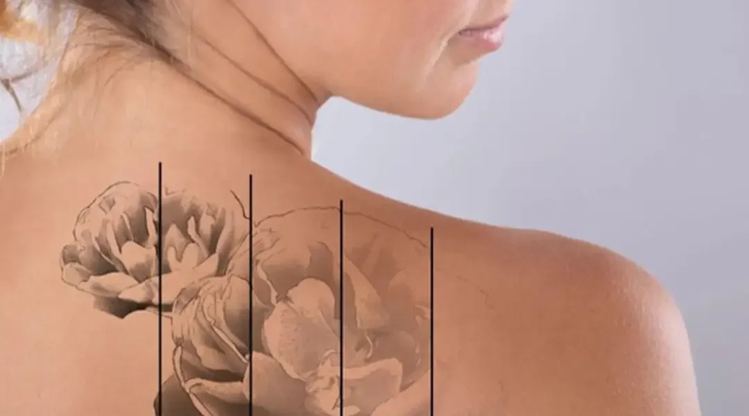 Tattoo Removal in India | Laser Tattoo Removal Agra