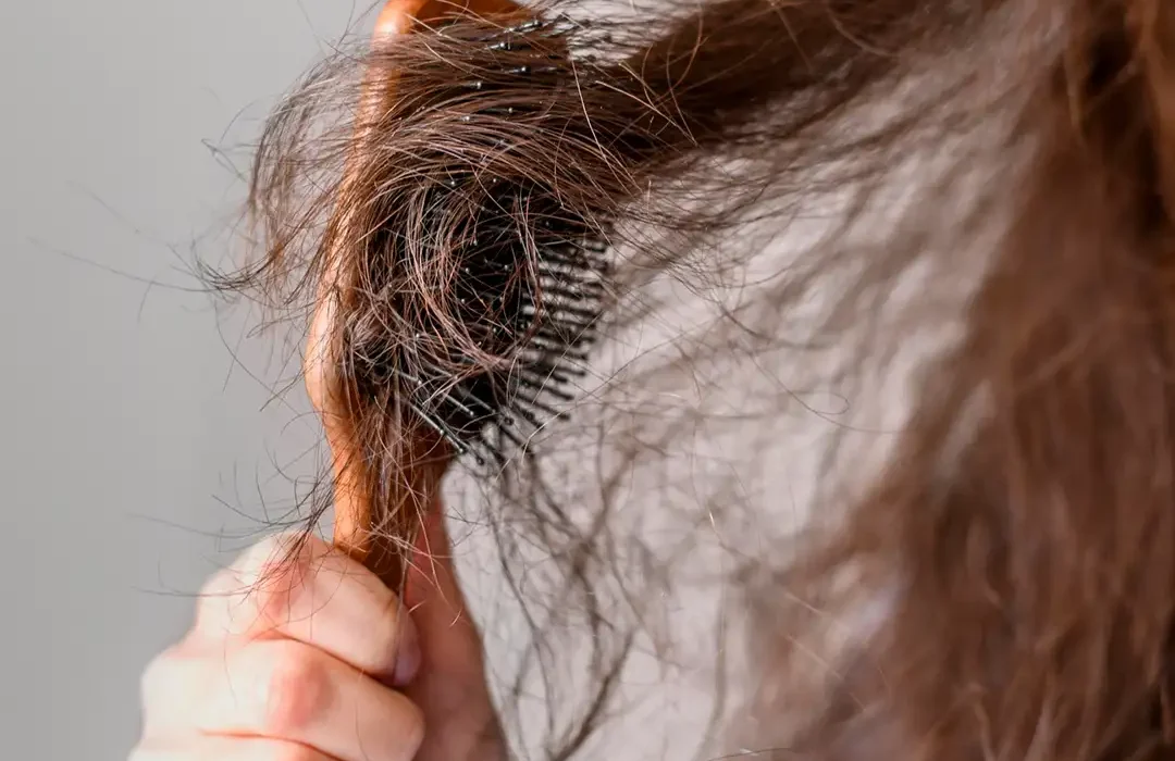 Hair Loss Treatment in Agra, India | Saraswat Hospital