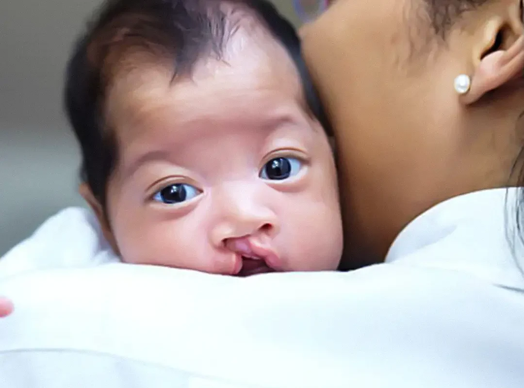 Cleft Lip and Cleft Palate: Causes & Treatment | Free Surgery