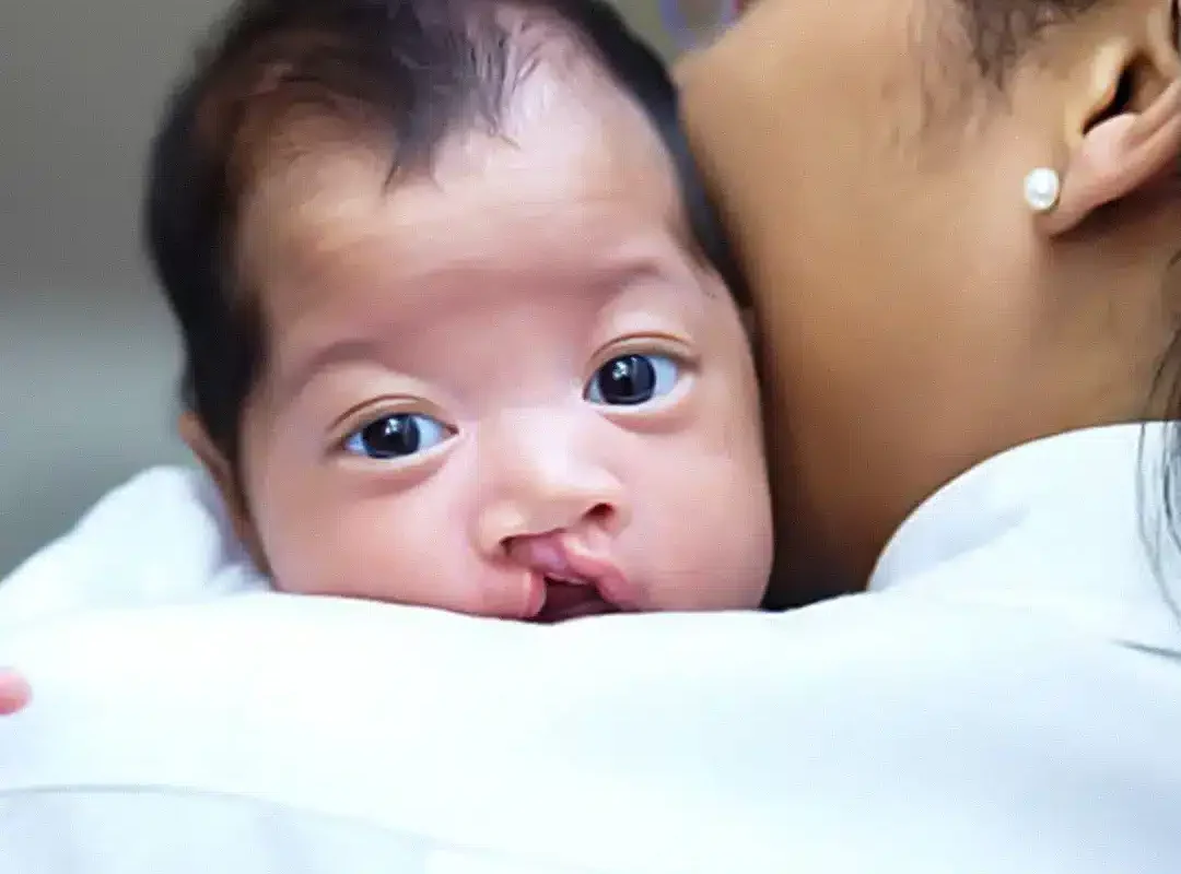 Cleft Lip and Cleft Palate: Causes & Treatment | Free Surgery