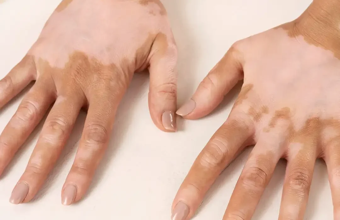 White Spot/Vitiligo Pigmentation on a Hand
