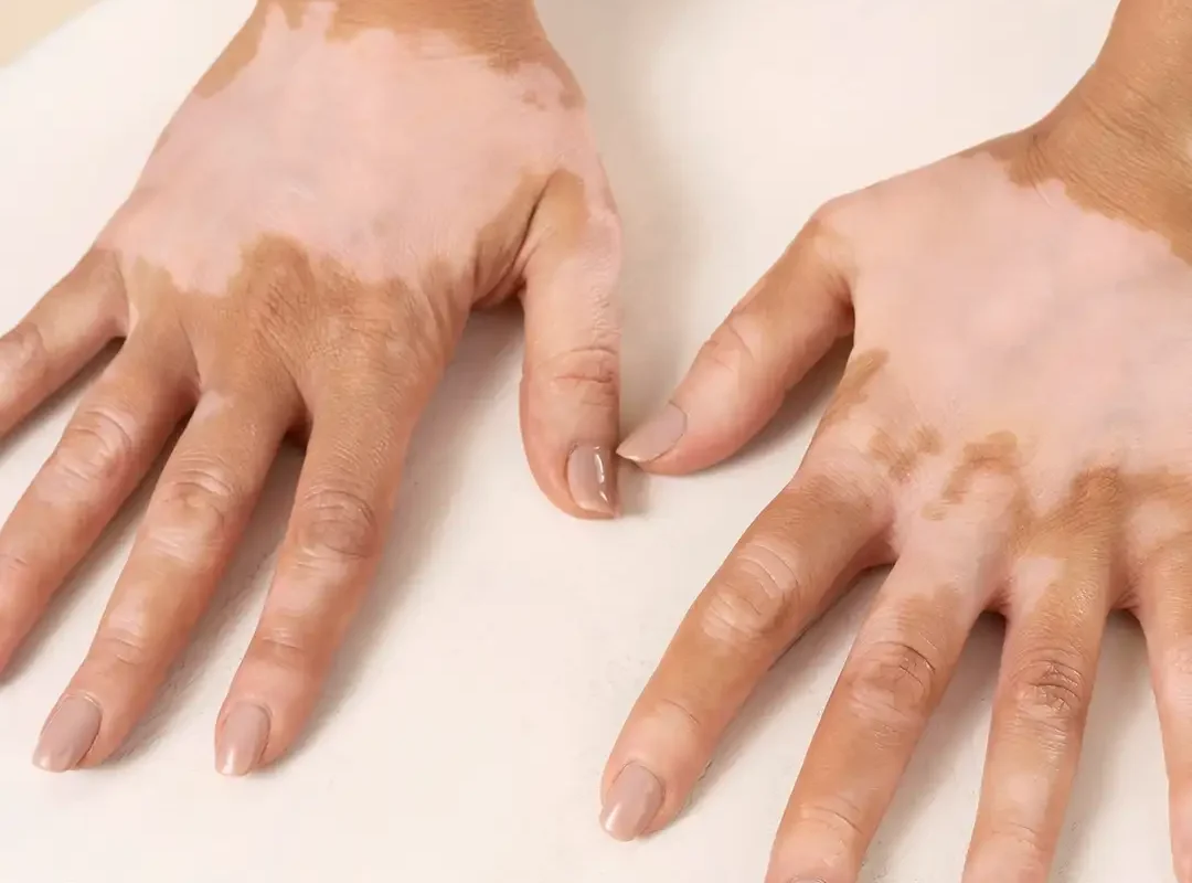 White Spot/Vitiligo Pigmentation on a Hand White Spot/Vitiligo Pigmentation on a Hand