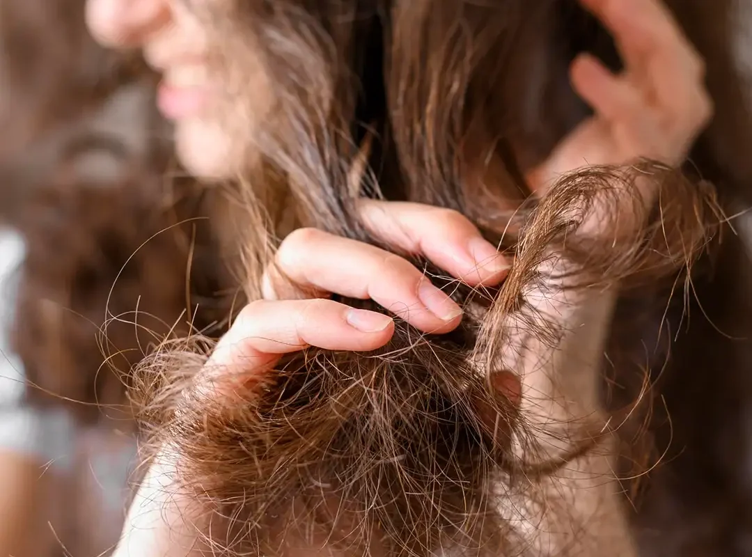 Hair Loss Treatment in Agra