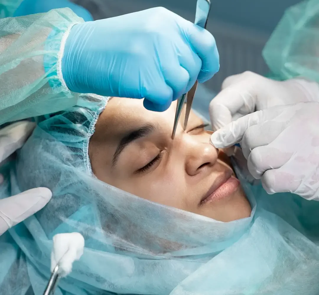 Rhinoplasty