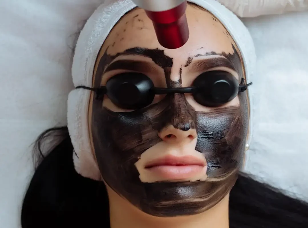 Carbon Peel Laser Treatment