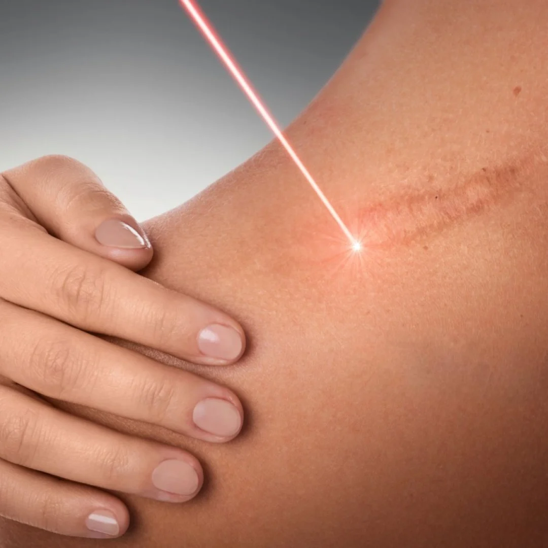 Scar Reduction Treatment in India | Types of Scars and Treatments
