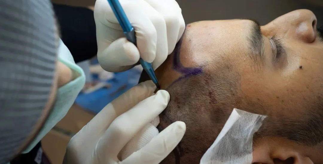 Repair Hair Transplant in India at Saraswat | Failed Hair Transplant