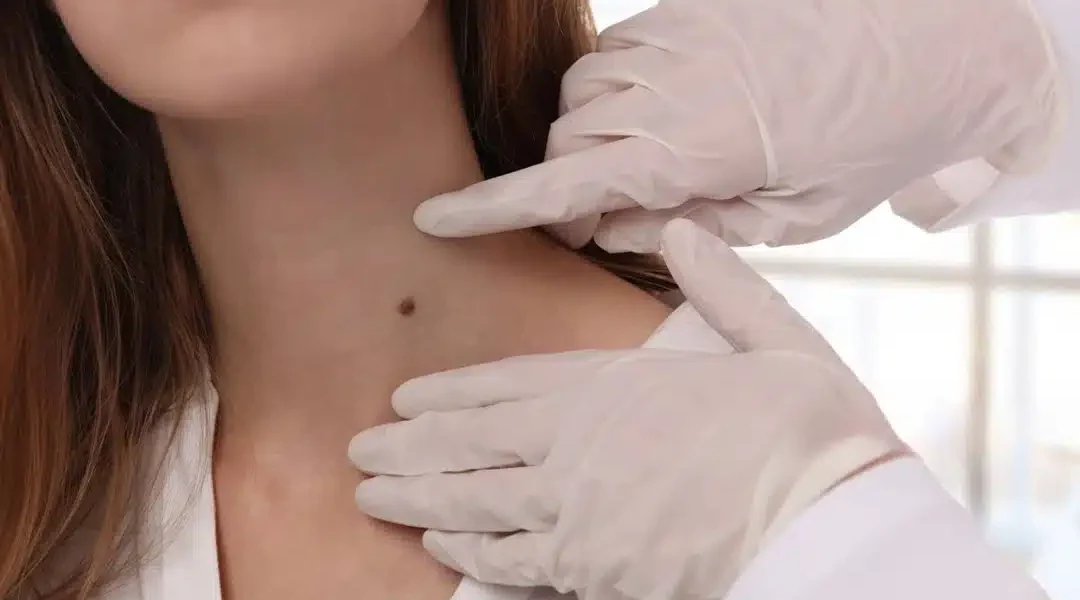 Warts & Moles Removal | Mole Removal in Agra | Laser Treatments