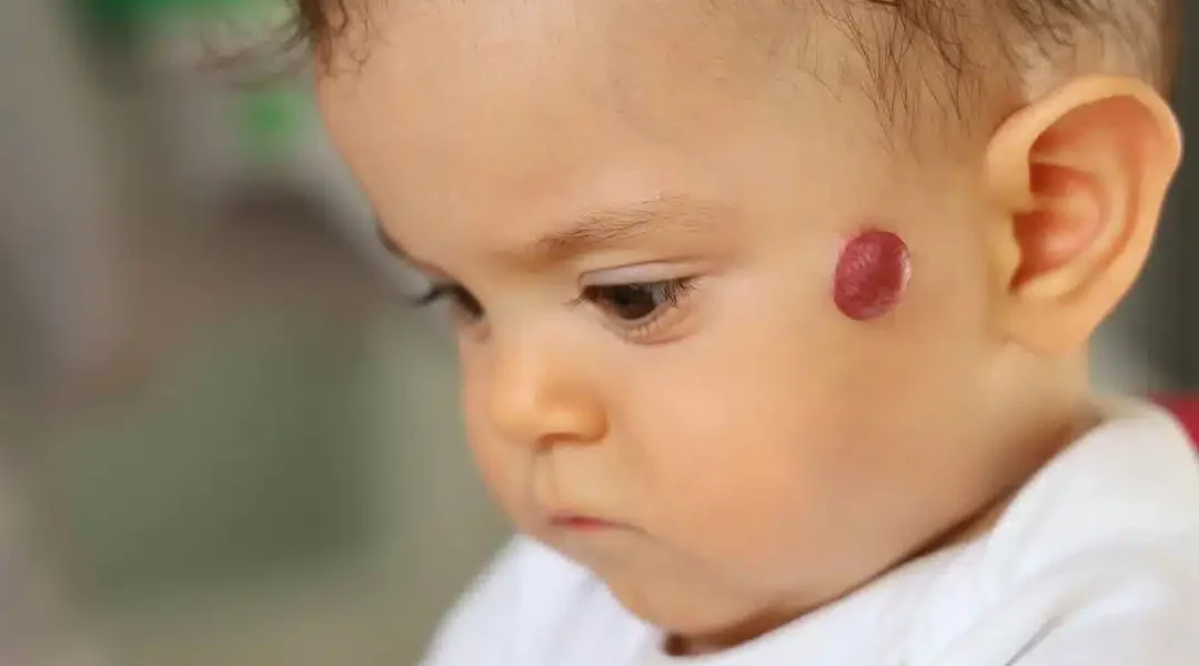 Haemangioma treatment