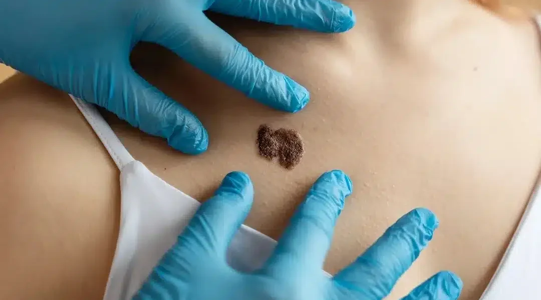 Causes of Skin Tags