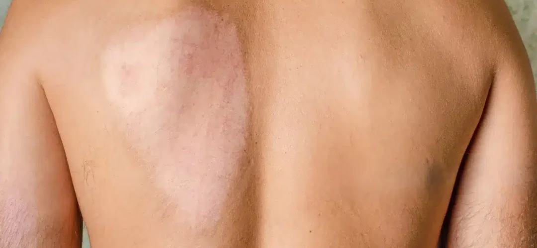 Best Skin Graft Surgery in India | Types, Benefits & Recovery