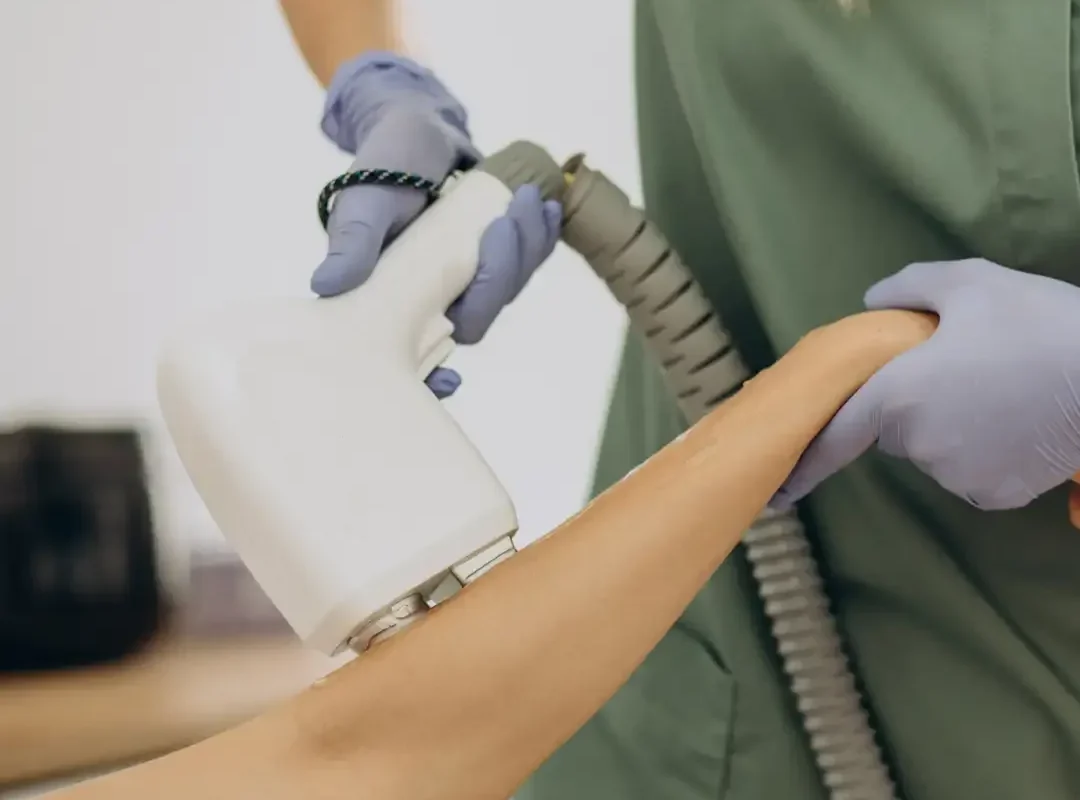 laser hair removal procedure